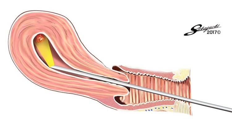 子宮鏡のイメージイラスト