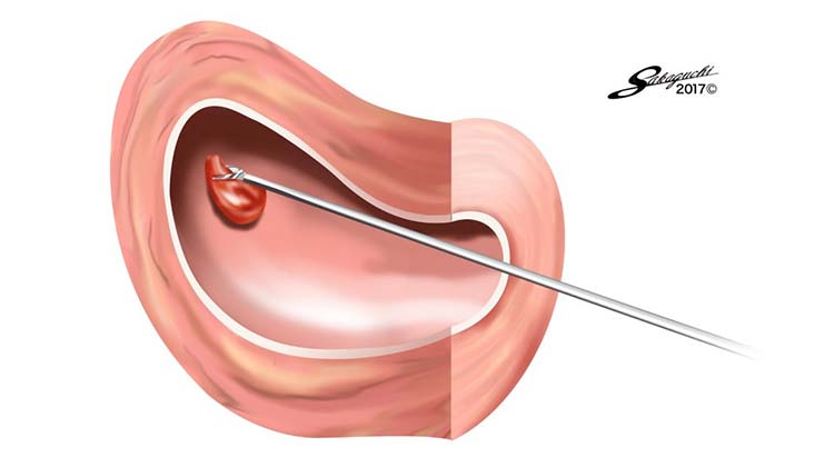 手術方法のイメージイラスト